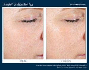 AlphaRet Exfoliating Peel Pads