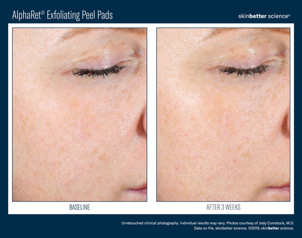 AlphaRet Exfoliating Peel Pads